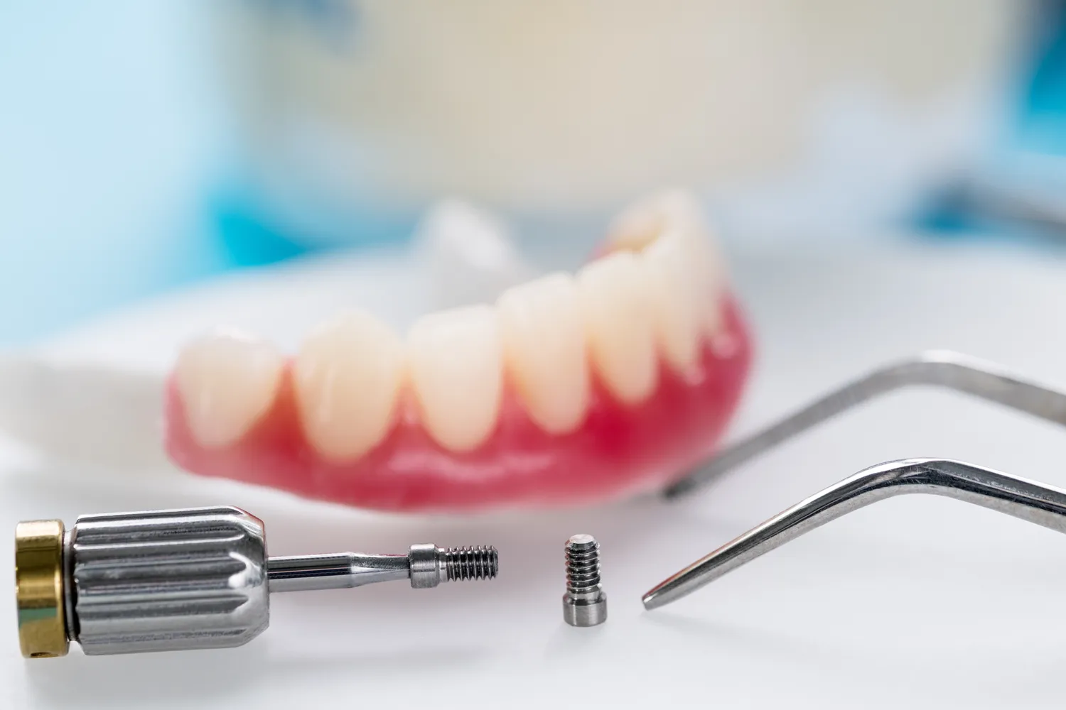 Jaki jest koszt implant贸w ca艂ej szcz臋ki?