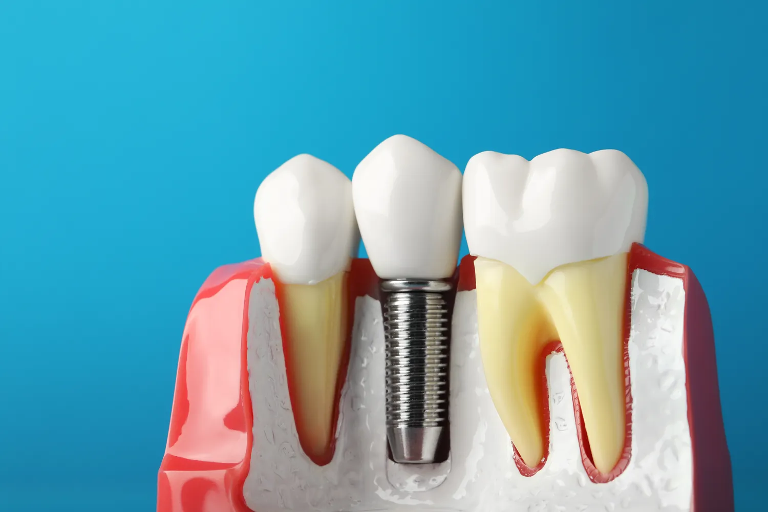 Kiedy po wyrwaniu z臋ba mo偶na wstawi膰 implant?